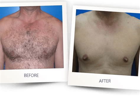 Chest Hair Removal The Ultimate Guide For Men Uncover