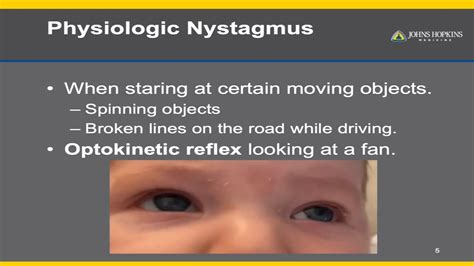 Nystagmus: The Essential Guide To Eye Disease